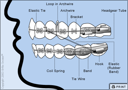 Parts of Your Braces